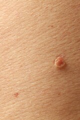 Man with mole on his skin, closeup