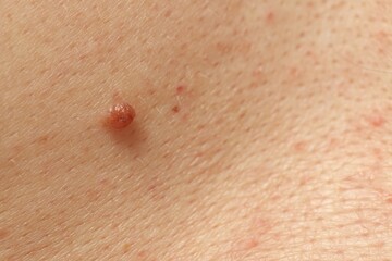 Man with mole on his skin, closeup