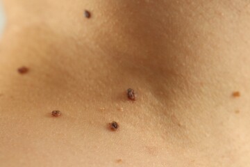 Woman with moles on her skin, closeup