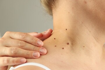 Doctor examining woman's moles on light grey background, closeup