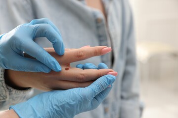 Doctor examining woman's moles in hospital, closeup