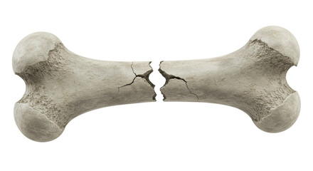 Isolated Broken Bone