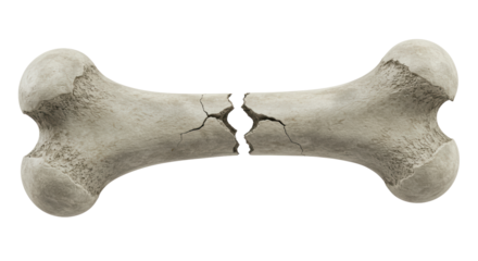 Isolated Broken Bone