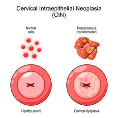 Cervical dysplasia. CIN. Process of cancer development
