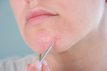 Purulent pimple on a woman's face. A woman uses a skin cleansing tool.