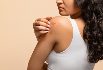 Unhappy young woman scratching her irritated skin on arm, annoyed indian female wearing white top...