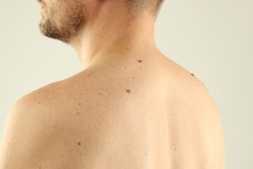 Naklejka premium Man with moles on his skin against light background, closeup