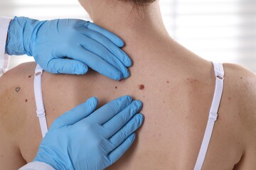 Doctor examining woman's moles in hospital, closeup