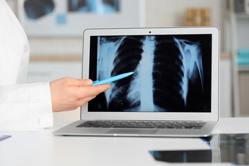 Male doctor showing x-ray scan of lungs on laptop in clinic, closeup