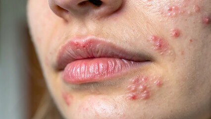 Inflamed Lips and Chin with Cracks – Angular Cheilitis or Lip Dermatitis Image