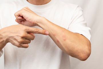 虫に刺された男性の腕