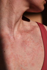 Close-up of woman skin affected by psoriasis. Eczema, rash and other skin diseases. Autoimmune genetic disease. Imperfect beauty.