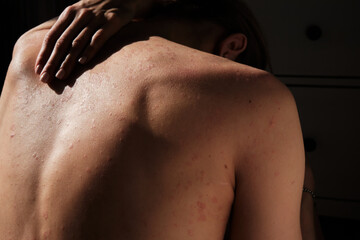 Close-up of woman touching her back, spine, skin affected by psoriasis. Eczema, rash and other skin diseases. Autoimmune genetic disease. Imperfect beauty.