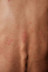 Close-up of woman skin affected by psoriasis. Eczema, rash and other skin diseases. Autoimmune genetic disease. Imperfect beauty.