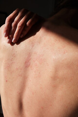 Close-up of woman touching her back, spine, skin affected by psoriasis. Eczema, rash and other skin diseases. Autoimmune genetic disease. Imperfect beauty.