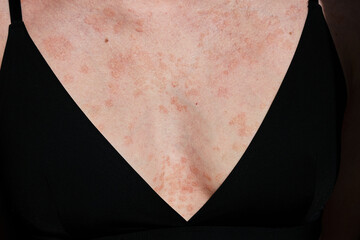 Close-up of woman skin affected by psoriasis. Eczema, rash and other skin diseases. Autoimmune genetic disease. Imperfect beauty.