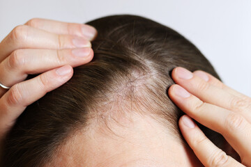 Initial stage of baldness, close-up. Young woman showing bald spots on forehead and temples. Hair...