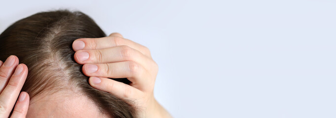 Initial stage of baldness, close-up. Young woman showing bald spots on forehead and temples. Hair...