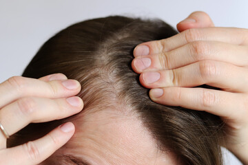 Initial stage of baldness, close-up. Young woman showing bald spots on forehead and temples. Hair...