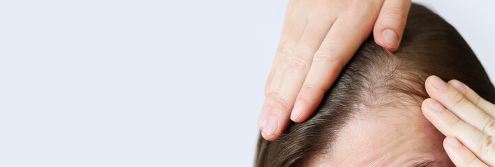 Initial stage of baldness, close-up. Young woman showing bald spots on forehead and temples. Hair...