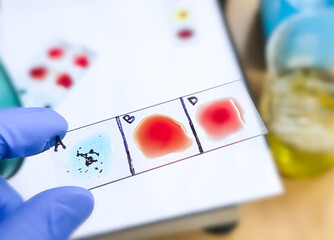 Blood group and Rh factor testing by slide agglutination method. Blood typing. A Negative (A-) blood group, a rare type of blood group.