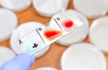 Blood group and Rh factor testing by slide agglutination method. Blood typing. A Negative (A-)...