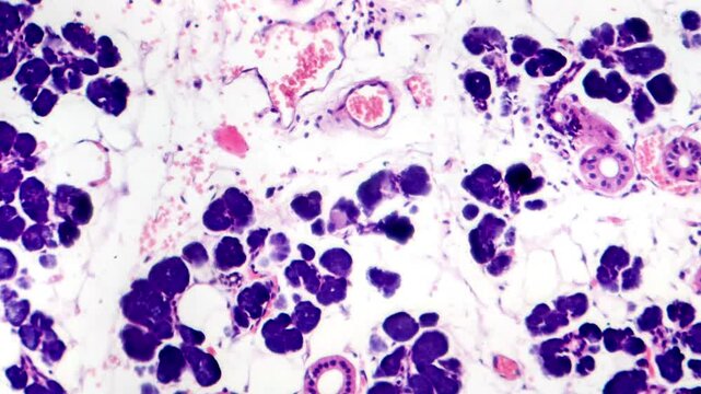 Mixed parotid tumor, light microscopy showing epithelial and myoepithelial cell components within chondromyxoid stroma, typical of pleomorphic adenoma.