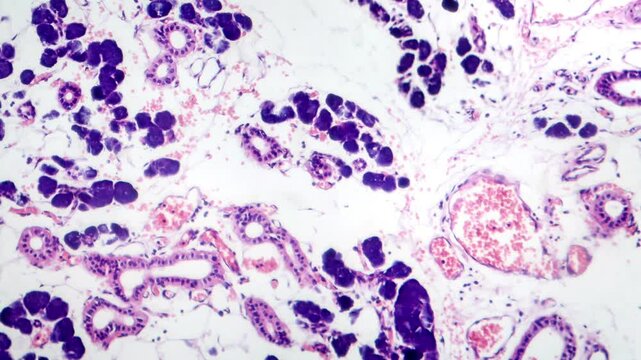 Mixed parotid tumor, light microscopy showing epithelial and myoepithelial cell components within chondromyxoid stroma, typical of pleomorphic adenoma.