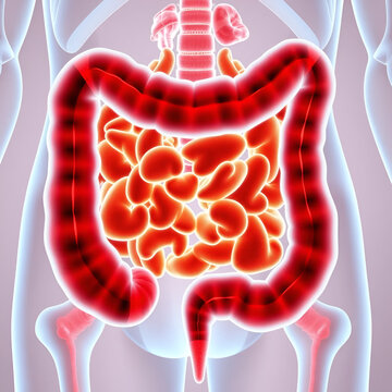 Colon, Colorectal cancer (CRC)