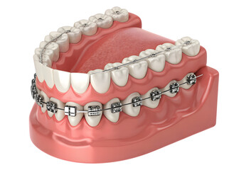 Dental orthodontic illustration showing teeth with metal braces and arch wires for correction