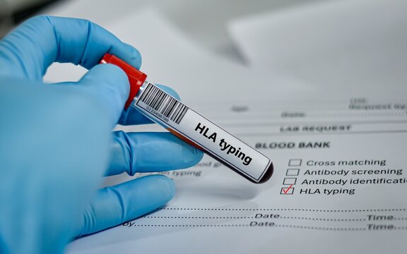 Blood sample tube for HLA typing test analysis