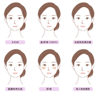 顔にできたシミの種類　美容　女性