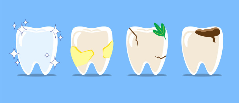 Healthy teeth, dental plaque, cracked tooth with food stuck, dental caries or tooth decayed . Set of flat design cartoon illustration . Isolated on Blue background . Vector .