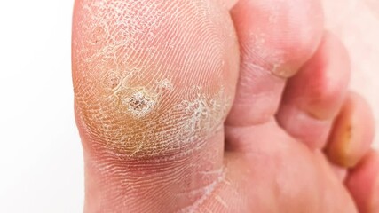 A wart on my toe. HPV plantar wart. Inflammation of the toe,rod callus,skin virus on the toe,animation.