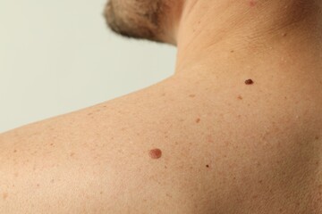 Naklejka premium Man with mole on his skin against light background, closeup