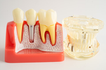 Dental implant, artificial tooth roots into jaw, root canal of dental treatment, gum disease, teeth model for dentist studying about dentistry.