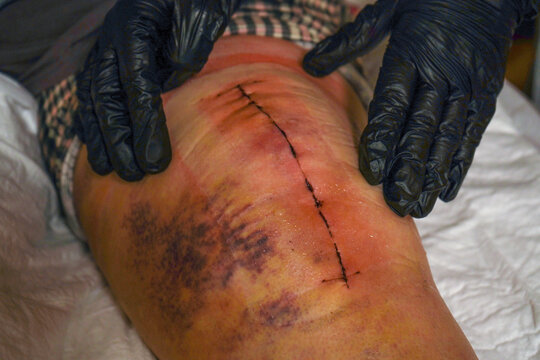 The doctor is assessing the condition of her knee, which has a scar from the procedure. This evaluation is part of her post-operative care following the joint replacement.