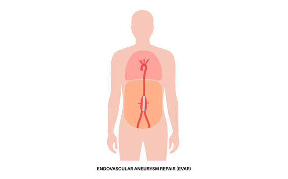 Abdominal Aortic Aneurysm