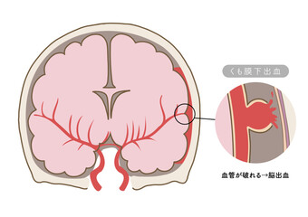 脳卒中の主な症状と脳血管の状態がわかる解剖イラスト