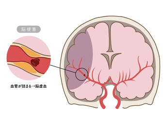 脳卒中の主な症状と脳血管の状態がわかる解剖イラスト