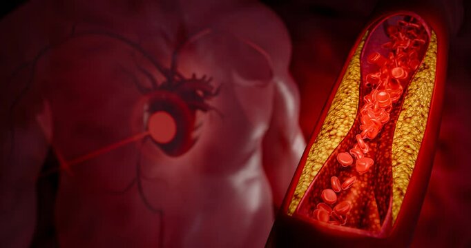 Vascular damage, artery clogging, and plaque buildup from junk food, high sugar consumption, processed foods, alcohol abuse, and poor lifestyle choices affecting heart health. 3D Rendering