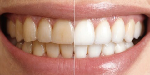 Before and After Teeth Whitening Transformation: Closeup of Healthy Teeth with False Teeth
