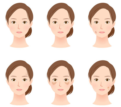 顔にできたシミの種類　美容　女性