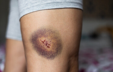 Naklejka premium Large bruise and wound on the leg