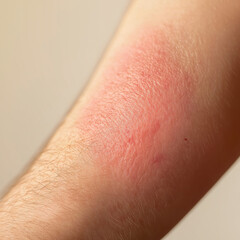 Close-up of irritated red skin on arm