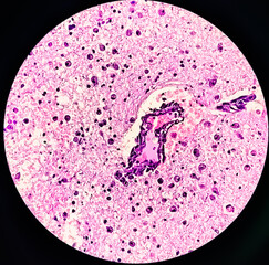 Highly magnified view of brain tumor. Oligodendroglioma of the brain. Brain glioma. Histological...