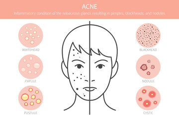 Acne skin condition. Skin diseases. Medical infographic design. Vector illustration
