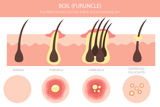 Boil, Furuncle, carbuncle. Skin diseases. Medical infographic design. Vector illustration