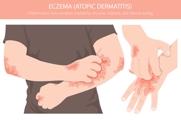 Eczema. Atopic dermatitis. Skin diseases. Medical infographic design. Vector illustration