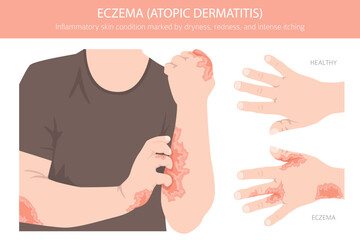 Eczema. Atopic dermatitis. Skin diseases. Medical infographic design. Vector illustration